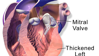 اعتلال العضلة القلبية