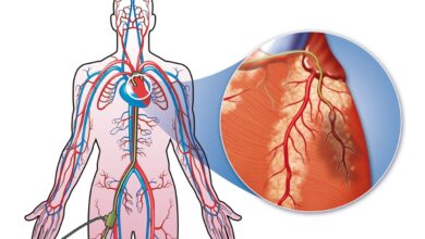 القسطرة القلبية: 4 حالات 14 متى تجرى القسطرة القلبية