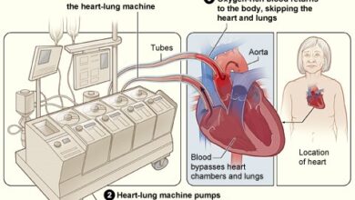 عملية تغيير شرايين القلب