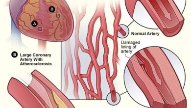 مرض القلب التاجي: 8 أعراض 18 مرض شريان القلب التاجي