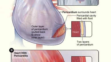 التهاب القلب: 3 أنواع 16 التهاب عضلة القلب