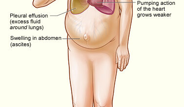 قصور القلب: 5 أسباب 17 قصور القلب: 5 أسباب