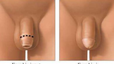 الختان والطهور الطبيعي