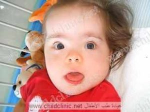 الطفل المنغولي: 6 أعراض 13 الطفل المنغولي