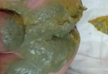 لون براز الطفل رمادي: 6 أسباب