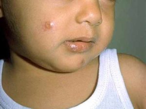 حبة حلب اللايشمانيا الجلدية 14 حبة حلب