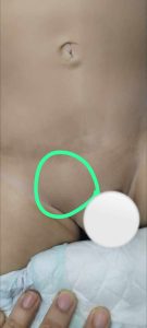 كتلة فوق قضيب الطفل: 3 أسباب 13 كتلة فوق قضيب الطفل