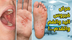 فيروس ومرض الفم واليد والقدم 14 فيروس ومرض الفم واليد والقدم