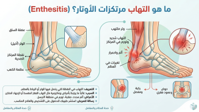 التهاب مرتكزات الاوتار
