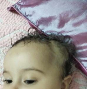 انتفاخ طري في رأس الطفل بعد سقوطه