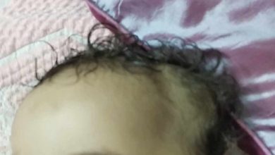 انتفاخ طري في رأس الطفل بعد سقوطه 26 انتفاخ طري في رأس الطفل بعد سقوطه