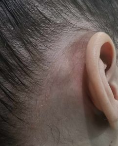 انتفاخ مؤلم خلف الاذن: 6 أسباب 13 ما الذي يسبب الألم والتورم خلف الأذن؟