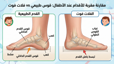 فلات فوت القدم المسطحة 17 فلات فوت القدم المسطحة