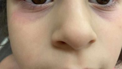 ظهور لون أحمر بنفسجي تحت عيون الطفلة