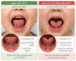 اللسان المربوط 2