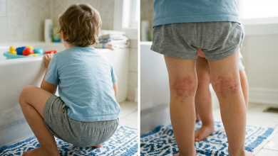 اكزيما تأتبية خلف الركبتين