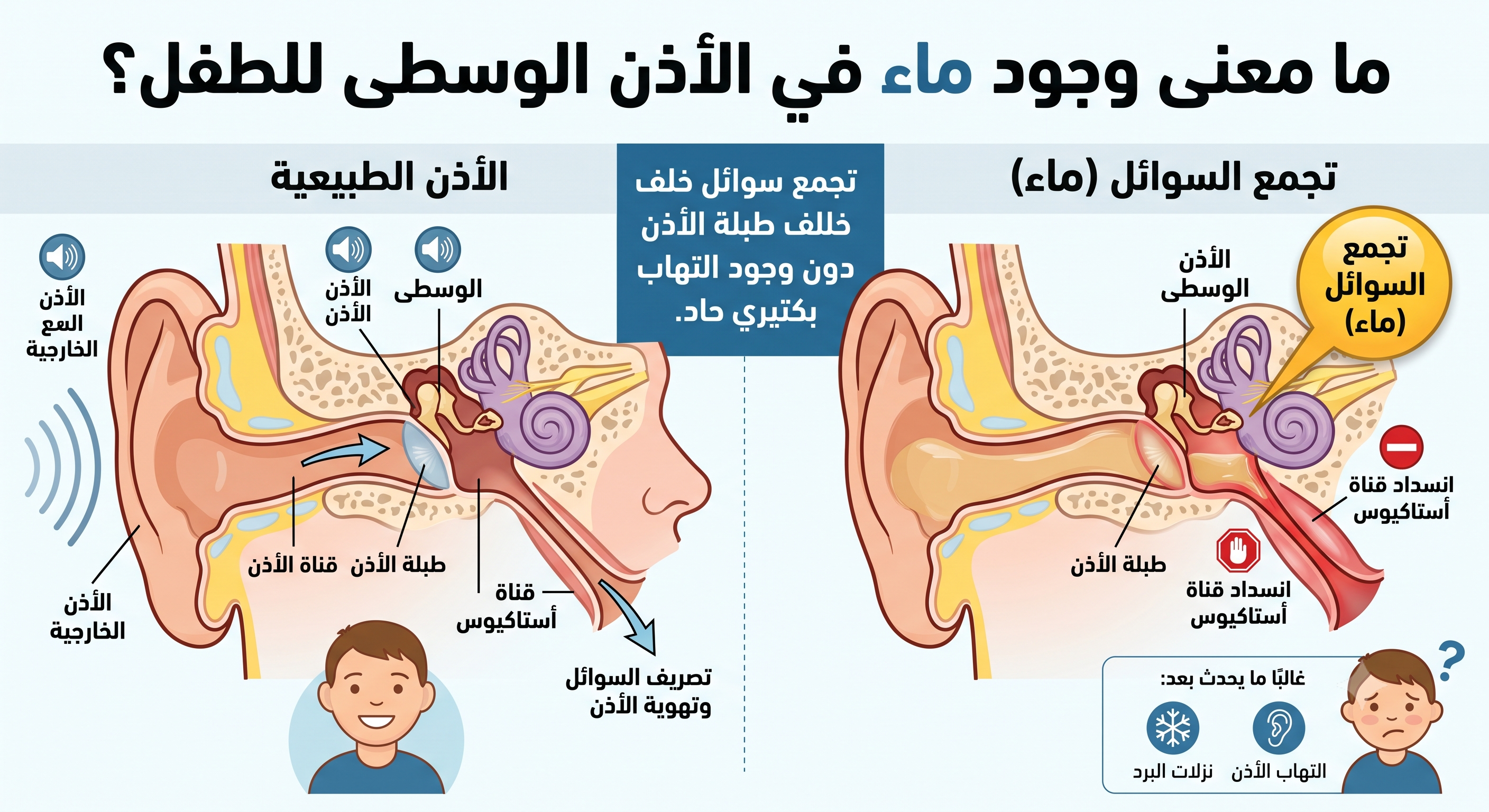 ماء خلف طبلة أذن الطفل 13 ماء خلف طبلة أذن الطفل 1