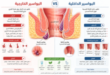 البواسير الخارجية والداخلية