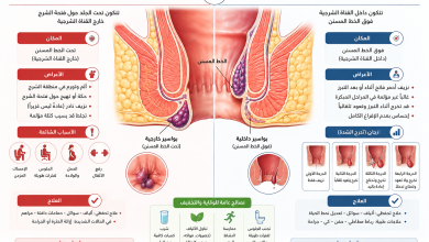 البواسير الخارجية والداخلية